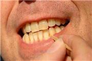 ضررهای استفاده از خلال دندان
