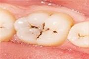 چرا پوسیدگی دندان ایرانی‌ها زیاد است؟