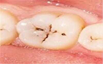 چرا پوسیدگی دندان ایرانی‌ها زیاد است؟