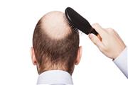 6 ریزمغذی موثر در جلوگیری از ریزش مو